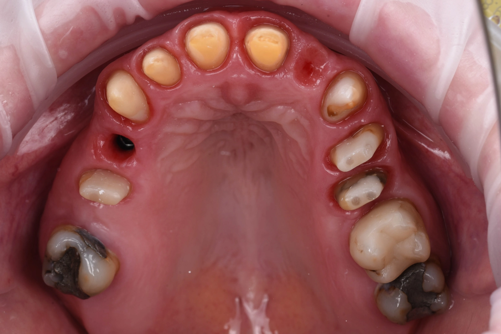Osteoplastika při hlubokých kazech