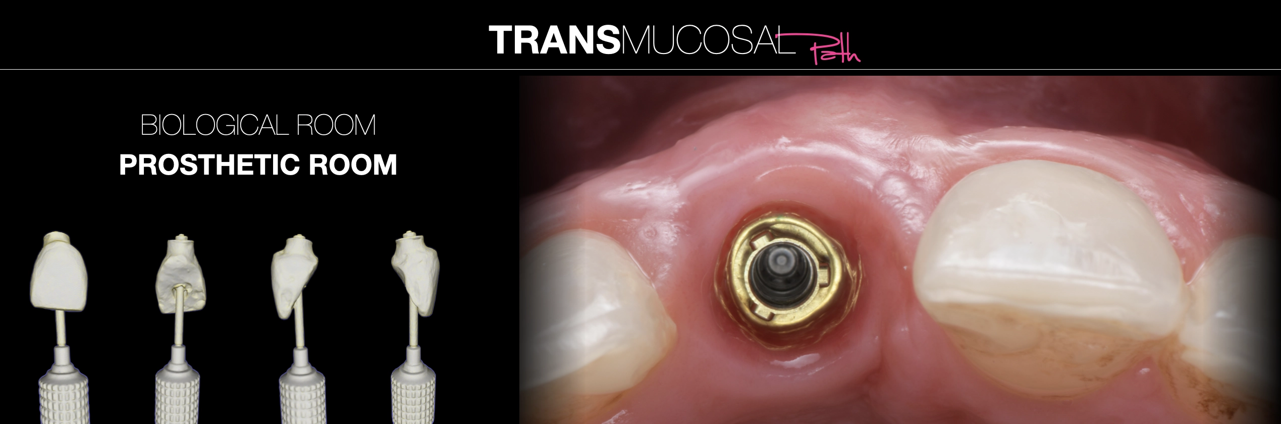 Techniky "Crown-Down" a "One Abutment One Time" - Rozhovor s Dr. Francescem Mintronem