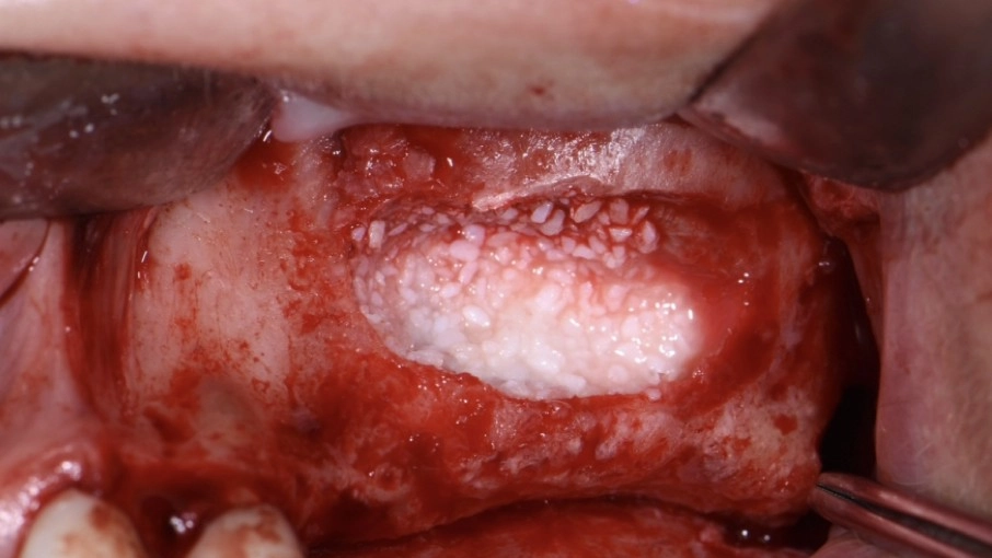 Laterální vs. krestální sinus lift a řešení komplikací Rozhovor s MUDr. Alešem Váňou