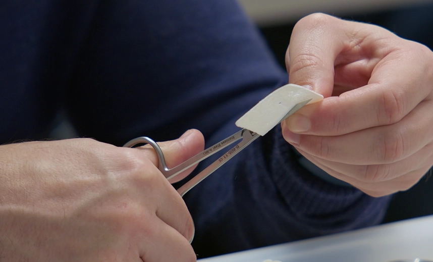 Řešení horizontální augmentace pomocí kortikální laminy v kombinaci s digitálním plánovaním