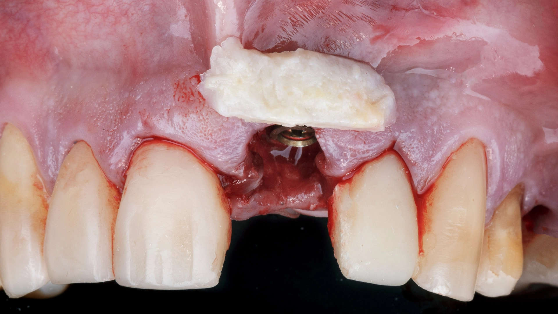 Management měkkých tkání kolem implantátů - Rozhovor s MUDr. Martinem Tomečkem